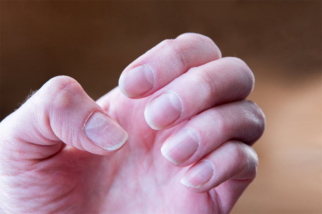 Considerations Surrounding the Removal of Dip Nails